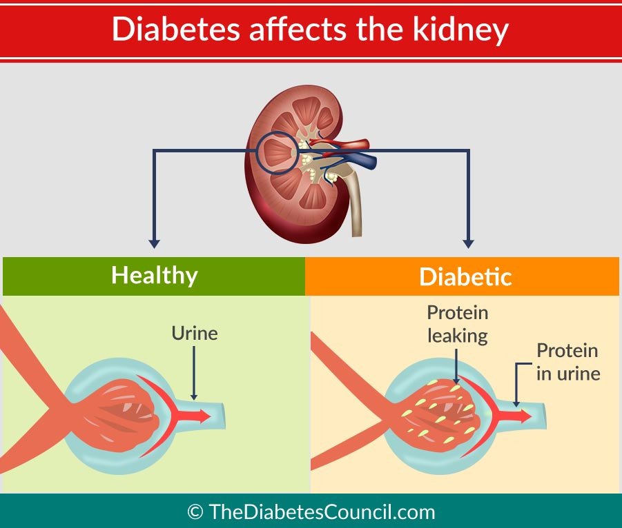 How Having Diabetes Can Affect Your Kidneys