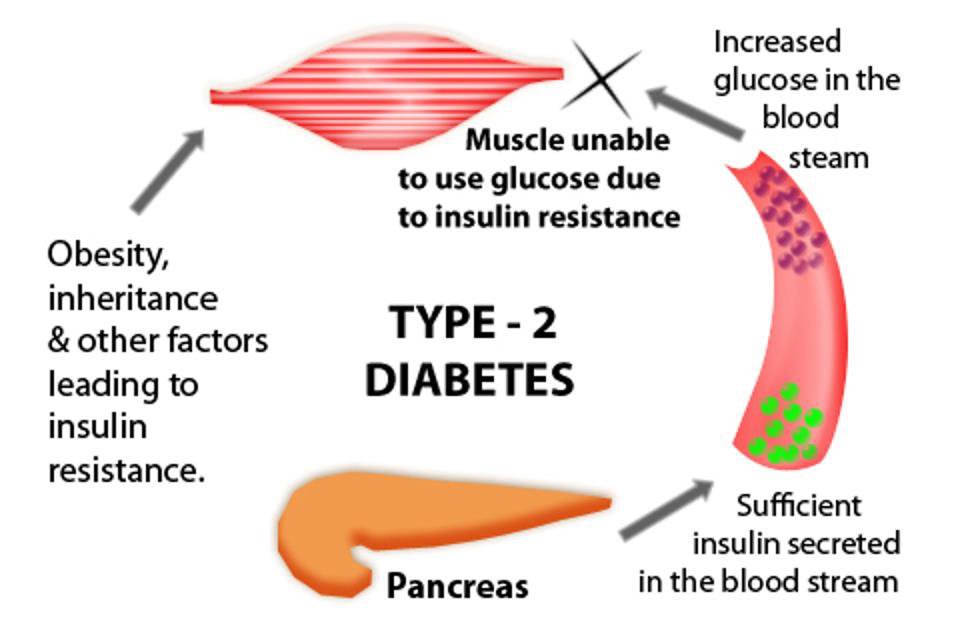 Type 2 Diabetes: Symptom, Causes, Medication ...